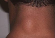 STAVILA SAM OVU NAMIRNICU NA MASNO TKIVO I ono je preko noći nestalo: EVO ŠTA ME SPASILO, SVI GA IMATE U KUĆI