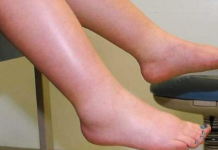 EVO KAKO DA IZBACITE VIŠAK VODE IZ TIJELA: Noge vam više neće biti natečene, evo šta trebate uraditi