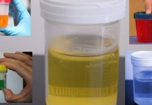 Često mokrite manje količine urina? Noću se budite da idete u wc? Ovo su simptomi jednog sindroma! Evo šta je u pitanju