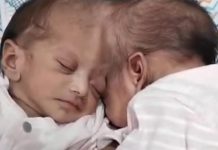 Kako žive Mina i Mirka, sijamske bliznakinje koje su turski doktori razdvojili: Prvih dana nisu mogle jedna bez druge