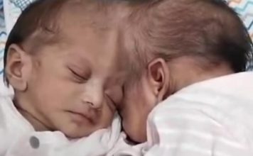 Kako žive Mina i Mirka, sijamske bliznakinje koje su turski doktori razdvojili: Prvih dana nisu mogle jedna bez druge