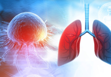 NAJNEOBIČNIJI SIMPTOM RAKA PLUĆA: Ubjeđivali je da ima alergiju, a sada joj je preostalo samo 6 meseci života