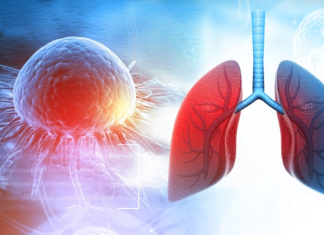 NAJNEOBIČNIJI SIMPTOM RAKA PLUĆA: Ubjeđivali je da ima alergiju, a sada joj je preostalo samo 6 meseci života