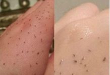 UTRLJAJTE OVO NA NOS I RUŽNI MITISERI ĆE SAMI ISPASTI: Trebaju vam samo 2 sastojka, a imate ih kući!