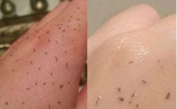 UTRLJAJTE OVO NA NOS I RUŽNI MITISERI ĆE SAMI ISPASTI: Trebaju vam samo 2 sastojka, a imate ih kući!