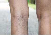 Prirodni RECEPT protiv bolova u nogama, proširenih vena i otoka: Ova dva sastojka stavite u vruću vodu i sačekajte 20 minuta – EVO efekta!