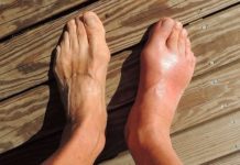 Evo tri narodna lijeka za giht kojima je cilj eliminirati mokraćnu kiselinu iz tijela, što predstavlja potencijalno rješenje za one koji traže olakšanje.