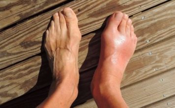 Evo tri narodna lijeka za giht kojima je cilj eliminirati mokraćnu kiselinu iz tijela, što predstavlja potencijalno rješenje za one koji traže olakšanje.