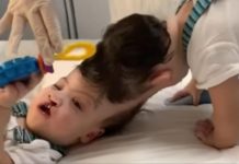 Rođeni sa spojenim lobanjama, život im je bio kazna: Kad su im mozak razdvojili, roditelji su gorko zažalili
