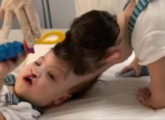 Rođeni sa spojenim lobanjama, život im je bio kazna: Kad su im mozak razdvojili, roditelji su gorko zažalili
