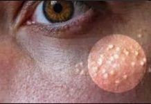 NI SLUČAJNO IH NE ISTISKUJTE, IMATE LI OVE BIJELE TAČKICE NA LICU? Uklanjaju se jednstavno, TREBAJU VAM 3 SASTOJKA KOJA IMATE U KUĆI