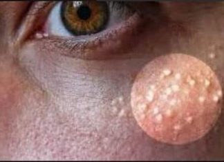 NI SLUČAJNO IH NE ISTISKUJTE, IMATE LI OVE BIJELE TAČKICE NA LICU? Uklanjaju se jednstavno, TREBAJU VAM 3 SASTOJKA KOJA IMATE U KUĆI