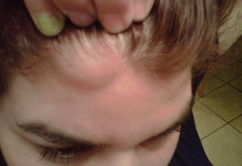 MASNO TKIVO NA VRATU, ISPOD PAZUHA, RUCI EVO KAKO GA UKLONITI