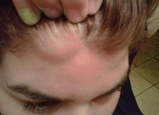 MASNO TKIVO NA VRATU, ISPOD PAZUHA, RUCI EVO KAKO GA UKLONITI