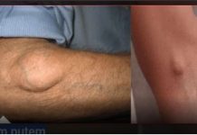 Ukoliko imate masno tkivo na koži, pročitajte tekst kako bi nestao prirodnim putem