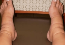 Lijek za proširene vene, otekline i bolove u nogama koji je dokazan godinama: DJELUJE bolje od skupih proizvoda!