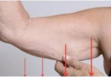 EVO ZAŠTO IMATE NEOBIČNO OBJEŠENU KOŽU- Većina ljudi nema pojma o ovom problemu. Jedino efikasno rješenje je ovaj domaći trik