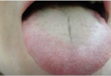 BIJELI PREMAZ NA JEZIKU? Nikada nemojte zanemariti ovaj simptom – 2 važna organa mogu biti oslabljena…