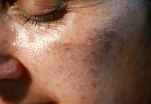 MAZALA JE LICE SA OVIM, STARAČKE PJEGE SU NESTALE: Ovako se zauvijek riješite SMEĐIH MRLJA sa kože, savjetuje poznati dermatolog