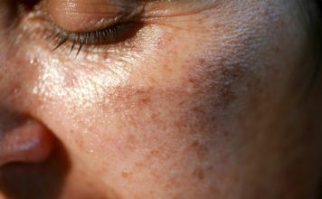 MAZALA JE LICE SA OVIM, STARAČKE PJEGE SU NESTALE: Ovako se zauvijek riješite SMEĐIH MRLJA sa kože, savjetuje poznati dermatolog