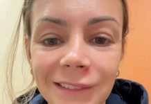 Mara je zbog bubuljice noć provela u hitnoj pomoći i jedva izvukla živu glavu: Sad upozorava ako vam izađe bubuljica na ovom mestu nikako je ne smete cediti