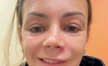 Mara je zbog bubuljice noć provela u hitnoj pomoći i jedva izvukla živu glavu: Sad upozorava ako vam izađe bubuljica na ovom mestu nikako je ne smete cediti