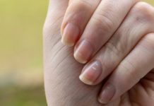 I nokti na nogama mogu da otkriju bolest: Ako PRIMIJETITE ove promene, moguće je da vas je napao „tihi ubica“