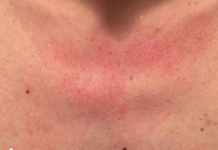 Zašto me tijelo svrbi nakon tuširanja Ako i vi imate crvene mrlje, evo zašto..