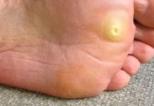 KURJE OKO MI NIJE DALO MIRA, OD BOLOVA NISAM MOGLA DA HODAM: A onda sam otkrila ovaj prirodni lijek, NESTALO JE ZA 2 DANA