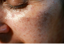MAZALA JE LICE SA OVIM, STARAČKE PJEGE SU NESTALE: Ovako se zauvijek riješite SMEĐIH MRLJA sa kože, savjetuje poznati dermatolog