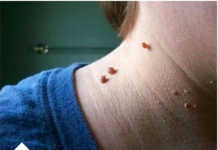 NERVIRAJU VAS SITNE BRADAVICE NA KOŽI? Evo kako da ih brzo uklonite, treba vam samo jedna namirnica!