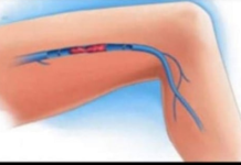 KAKO PREPOZNATI SIMPTOME TROMBA? Ovo su znakovi na koje trebate obratiti pažnju: Kada se krvni ugrušak nađe u blizini srca javljaju se sljedeći simptomi