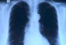 Opaka bolest u porastu, izdali upozorenje građanima: Ovo su simptomi