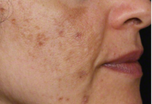 Evo kako da sa ovim jednostavnim trikom od 2 sastojka izbrišete mrlje s kože!