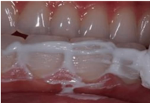 Domaći recept : Kako da UKLONITE kamenac, upalu desni i izbijelite zube u samo 4 koraka!