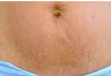 DOKTORICA NAŠLA RJEŠENJE ZA SVE BUDUĆE MAME: Kako da se riješite OŽILJAKA, STRIJA I MRLJA nakon trudnoće! Evo šta trebate uraditi