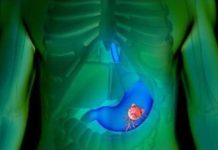 6 NAJRANIJIH SIMPTOMA RAKA ŽELUCA: Ovako tijelo šalje znak da se u organizmu razvija opaki tumor!