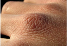 Puca vam koža, opada kosa ili imate grčeve? Tijelo vam govori da vam nedostaju ovi vitamini