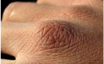 Puca vam koža, opada kosa ili imate grčeve? Tijelo vam govori da vam nedostaju ovi vitamini