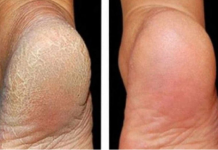 ZA MEKA STOPALA POTREBNA SU VAM SAMO 3 SASTOJKA IZ KUHINJE: Potopite noge u ovu smjesu na 15 minuta i recite zbogom ispucalim petama