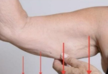 EVO ZAŠTO IMATE NEOBIČNO OBJEŠENU KOŽU – Većina ljudi nema pojma o ovom problemu. Jedino efikasno rješenje je ovaj domaći trik