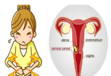 KLJUČNO ZA SPAS: Većina žena zanemari OVA TRI rana znaka raka grlića maternice!