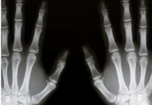 PRVl SlMPTOM KARClN0MA K0STlJU: 0vaj znak ukazuje na smrtonosnu bolest …