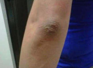 OVA PROMJENA NA LAKTU GOVORI DA SA VAŠIM ORGANIZMOM NEŠTO NIJE U REDU: EVO O KAKVOJ BOLESTI SE RADI