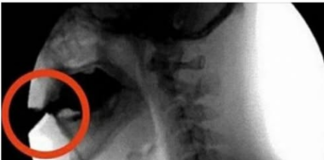 OVAJ OTROV UNIŠTAVA VAŠE KOSTI: Većina ga konzumira barem jednom dnevno