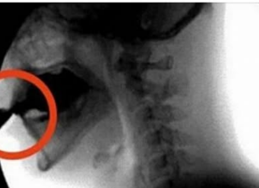 OVAJ OTROV UNIŠTAVA VAŠE KOSTI: Većina ga konzumira barem jednom dnevno
