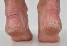 Jeftino čudo iz kuhinje koje spašava vaša stopala: Kao rukom rješava ispucale peta, gljivice i kurje oči