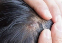 BUBULJICE NA GLAVI SU SVE ČEŠĆI PROBLEM: Ni slučajno ih ne istiskujte, evo zašto se javljaju I ŠTA TREBATE URADITI DA NESTANU