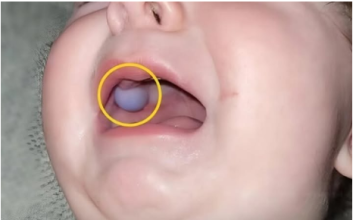 Majka je primetila nešto neobično u ustima svog devetomesečnog sina i odmah je otišla kod lekara — otkriće lekara bilo je iznenađujuće.