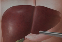 Jetra pod pritiskom: namirnice koje je opterećuju gotovo kao alkohol